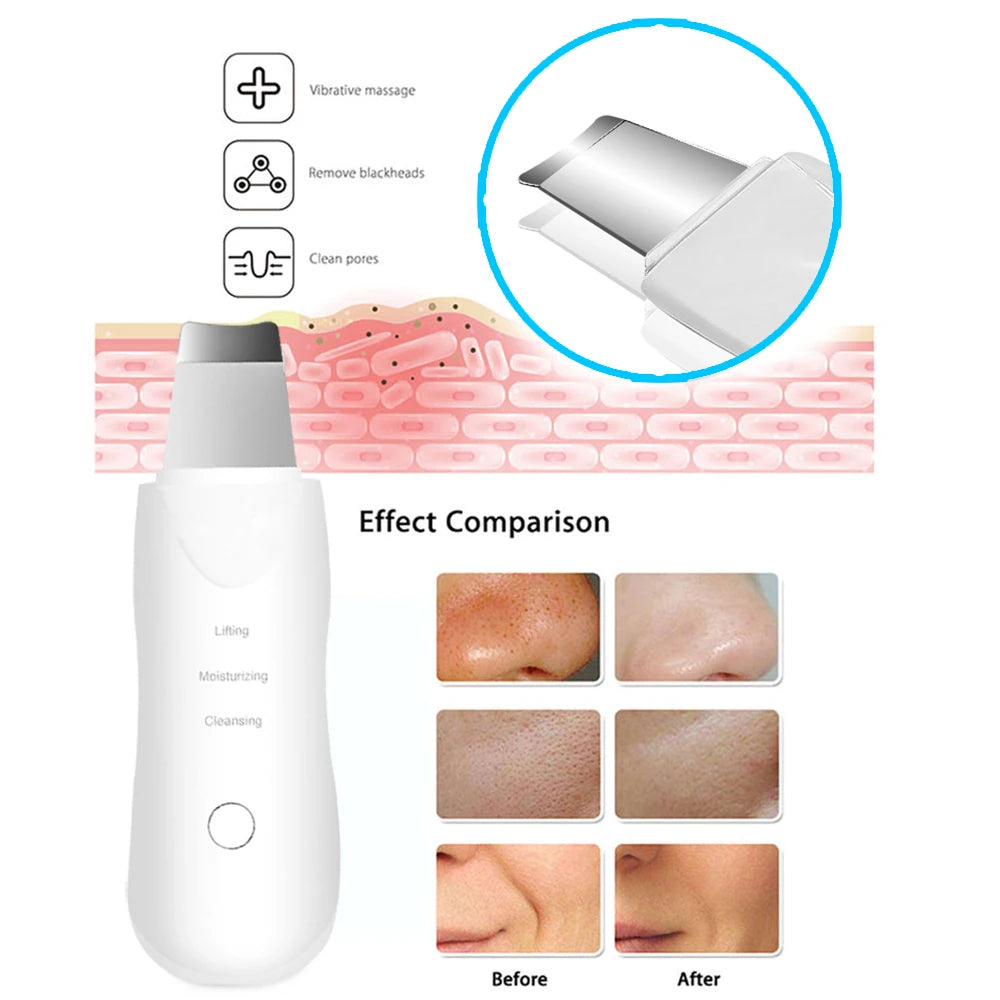 Ultrasonic Skin Scrubber/Facial Shovel